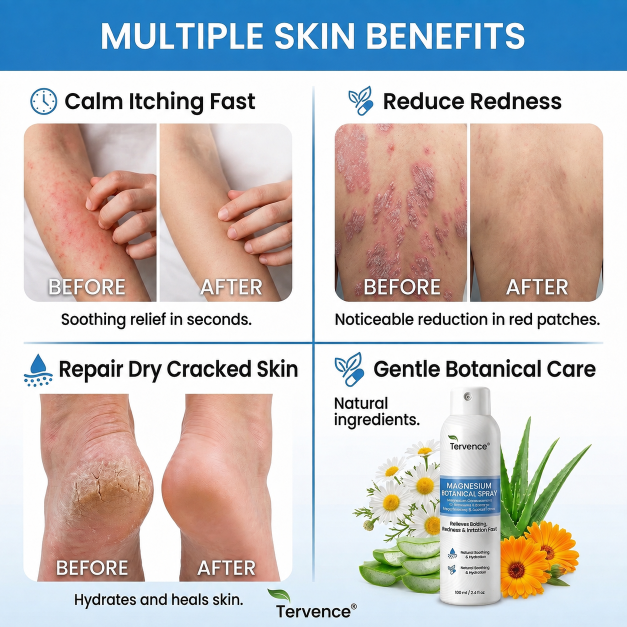 ✨Tervence® Magnesium Botanical Spray –  Advanced Skin Recovery for Psoriasis & Eczema | Rapid Soothing, Steroid-Free