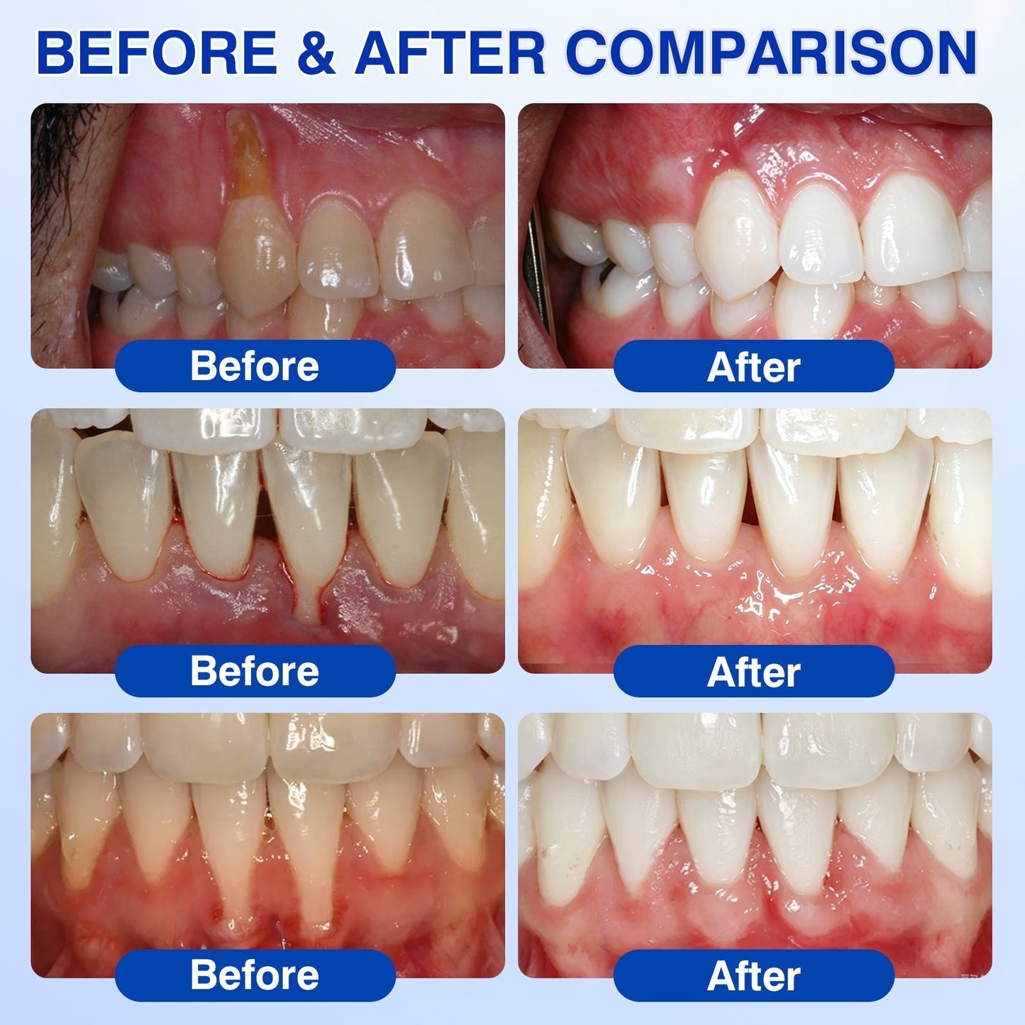 🇬🇧👨‍⚕️🦷🛡️BBOJI® GumRevive Periodontal Repair Gel