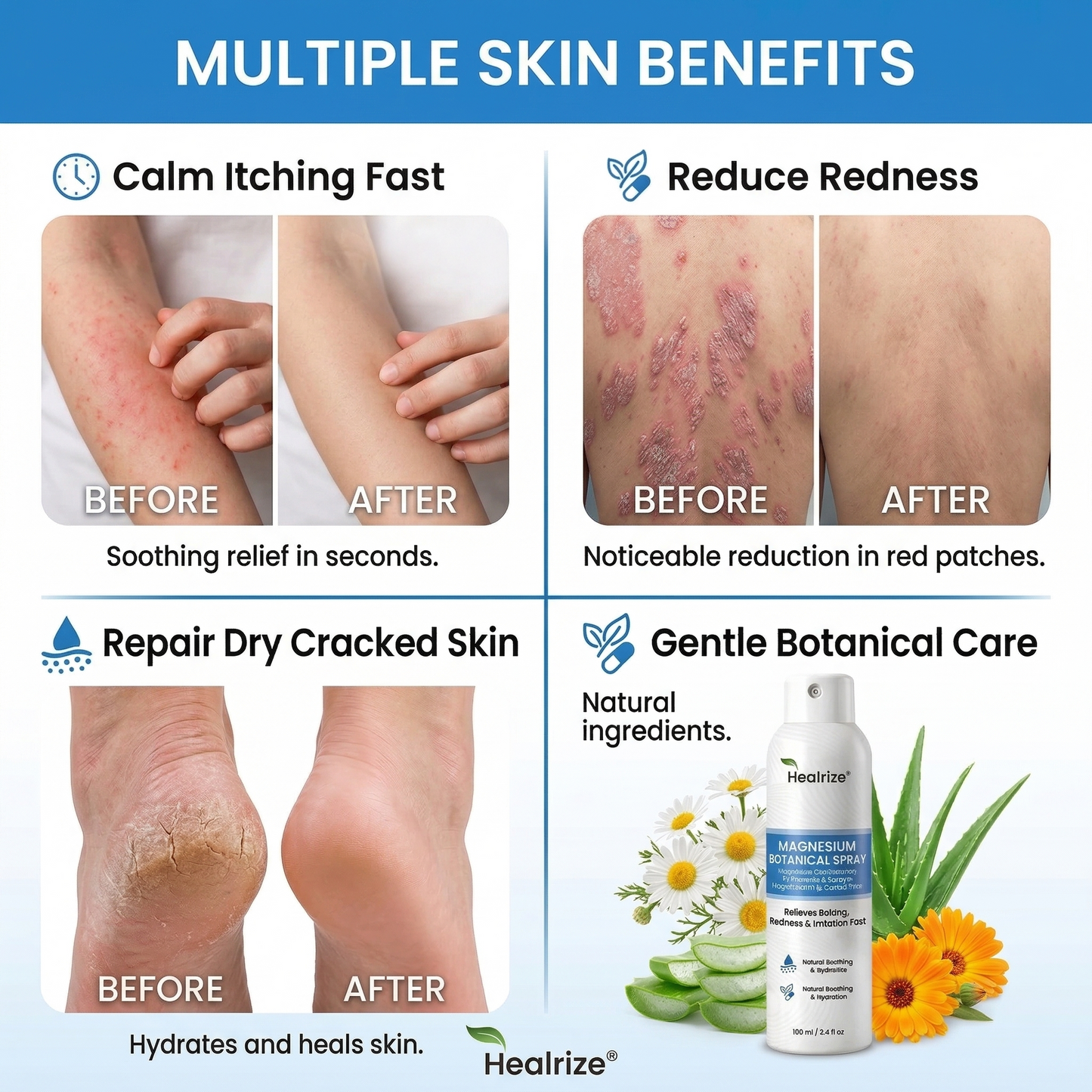 ✨Tervence® Magnesium Botanical Spray –  Advanced Skin Recovery for Psoriasis & Eczema | Rapid Soothing, Steroid-Free