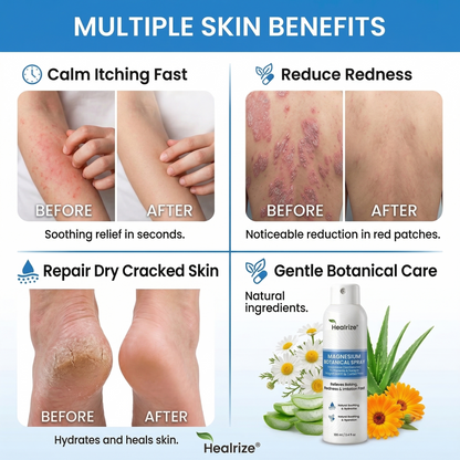 ✨Tervence® Magnesium Botanical Spray –  Advanced Skin Recovery for Psoriasis & Eczema | Rapid Soothing, Steroid-Free