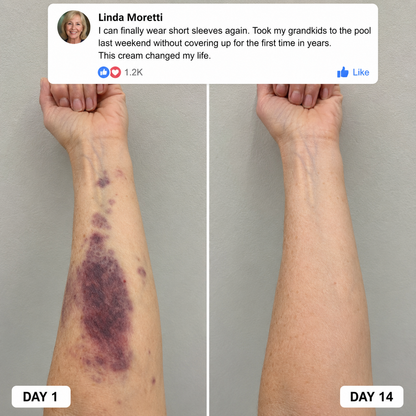 Tervence™ Bruise Repair & Skin — Strengthening Cream